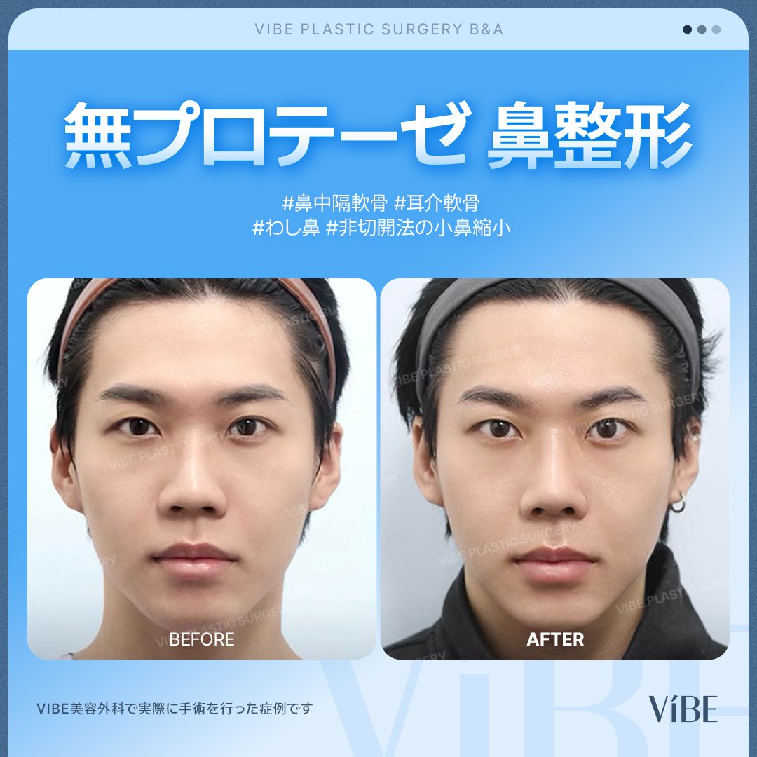 vibeprs's tweet photo. VIBE 無プロテーゼ鼻整形

耳軟骨と鼻中隔軟骨のみで形成する、
自然で美しい鼻先👃
小鼻縮小も非切開で負担を最小限に⬇️

鼻を変えただけで顔全体の印象が変わります✨

#韓国クリニック #鼻整形 #メンズ整形 #小鼻縮小

💡5月東京相談会、のこりわずか！

📅 日程：26.5.30(土)～26.5.31(日)
📍 場所：東京🗼

⚠️人数限定・先着順！
ご予約はお早めに👇
🩵お問い合わせ・お申込み：プロフィールリンクにて