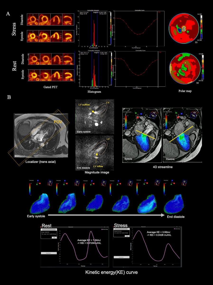 CFD_Inc's tweet photo. 🫀📄 新規論文紹介

このたび、以下の論文をご紹介いたします。

「Assessment of left ventricular mechanical synchrony and intraventricular blood flow energy in ischemic heart disease using a hybrid positron emission tomography-magnetic resonance system」

--> https://t.co/0cYd2f14CI