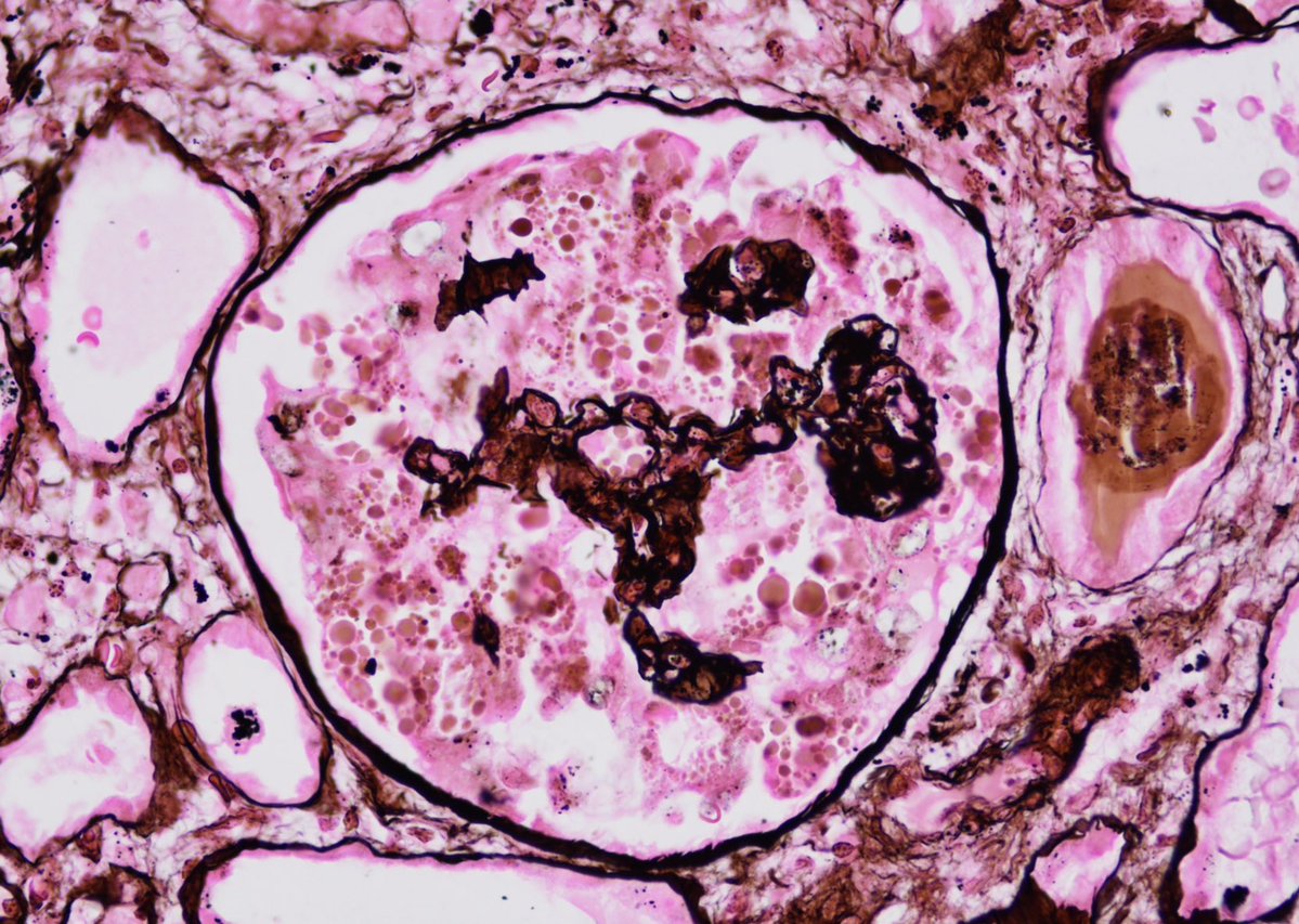 kanishk10246585's tweet photo. Rare renal manifestation of malaria-associated AKI.

Kidney biopsy showed collapsing glomerulopathy with severe acute tubular injury in a patient with P. vivax infection. IF negative.

An uncommon but important association.
#NephPath #RenalPath#KidneyBiopsy #Malaria #CollapsingGN https://t.co/CKASELOsXa