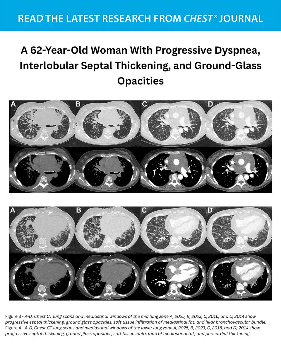 journal_CHEST's tweet photo. A 62-Year-Old Woman With Progressive Dyspnea, Interlobular Septal Thickening, and Ground-Glass Opacities
What's the diagnosis? Read the full CHEST Pearl in the May issue of the journal CHEST®: https://t.co/B3WY6eQzdW
#MedEd #JournalCHEST https://t.co/SP4Orl5YXT