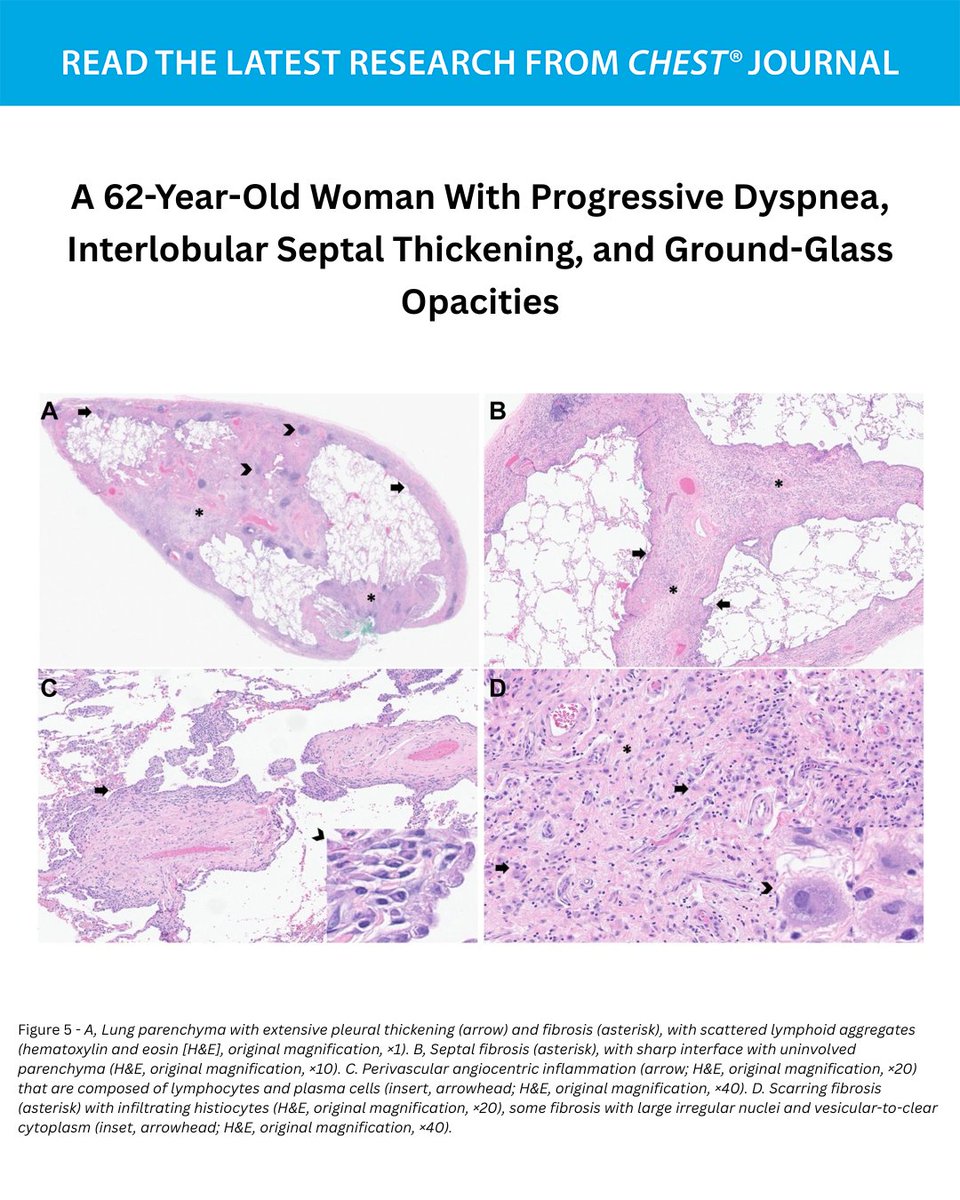 journal_CHEST's tweet photo. A 62-Year-Old Woman With Progressive Dyspnea, Interlobular Septal Thickening, and Ground-Glass Opacities
What's the diagnosis? Read the full CHEST Pearl in the May issue of the journal CHEST®: https://t.co/B3WY6eQzdW
#MedEd #JournalCHEST https://t.co/SP4Orl5YXT