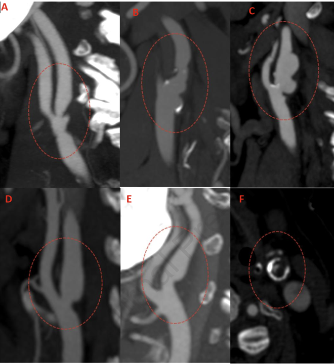 draravindganesh's tweet photo. 🚨In this study of nonstenotic carotid disease in Manitoba, we show the role of plaque thickness+ ulceration in⏫risk of recurrent stroke. Kudos to @nishita_singh3 for building this team from the ground up &amp; to med student Kamran on the paper! @NimaKashani https://t.co/AnlNzFHhiO https://t.co/V2J6XYvoVe