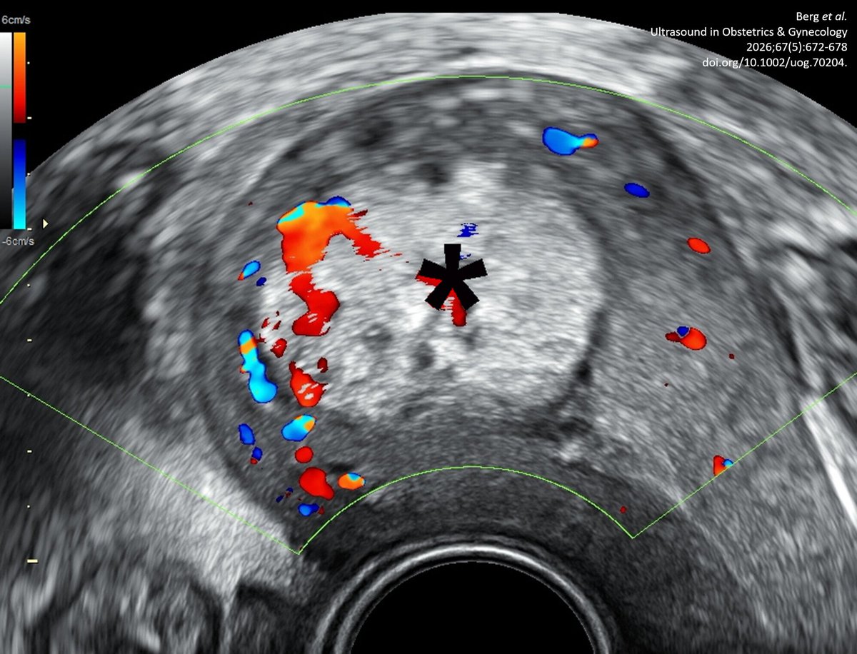 ISUOG's tweet photo. A recent #openaccess case–control study by Berg et al. identifies risk factors for partial placental retention after Cesarean delivery. 

Read their conclusions in #UOGJournal today: https://t.co/gbiscRnEY2

@WileyHealth 

#LoveUltrasound #ISUOG2026 https://t.co/ws5XeSQSkF