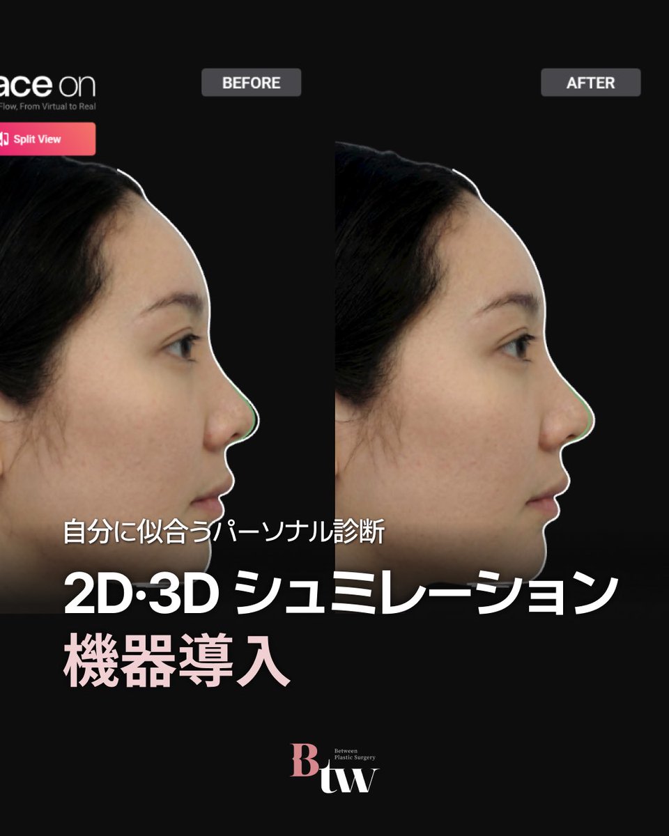 betweenps's tweet photo. 2D・3Dシミュレーション機器導入✨​

🏥BETWEEN美容整形外科​
🇯🇵日本語対応​
📍9号線シンノニョン駅7番出口目の前​
💌ご予約はプロフィールから公式ラインへお問い合わせください​
​
#鼻整形  #韓国整形  #韓国美容 https://t.co/21Ops7Qlsm