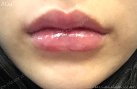 lpps_jp's tweet photo. 当院の自然なリップフィラー施術にご満足いただき、ありがとうございます💕
またお会いしましょう！

オリニコンジュ美容整形外科💖

LINE相談=@793jjgaa

#オリンコンジュ整形外科 #唇フィラー #リップフィラー #渡韓 #韓国整形 #口角ボトックス #フィラー #唇ヒアルロン酸 #唇ヒアル #ヒアルロン酸 https://t.co/GbBZGCzove