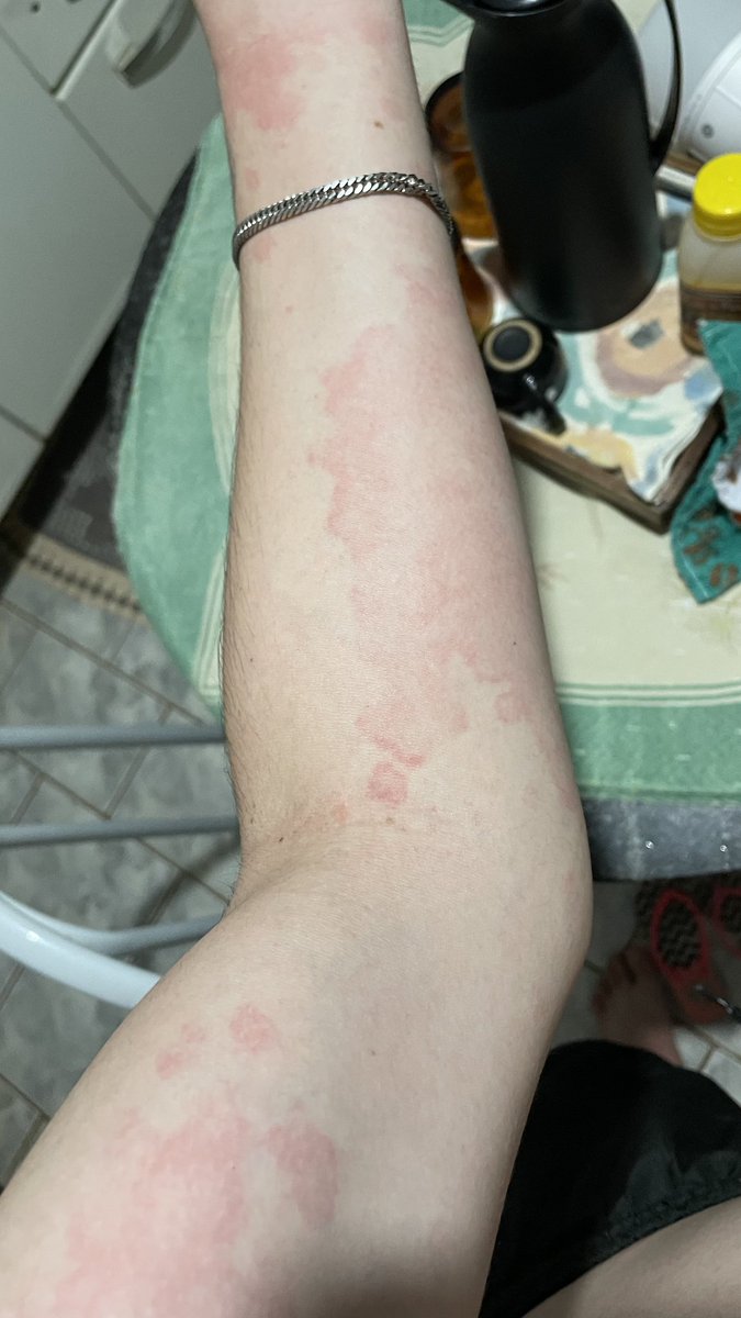 MIAUCARAIOO's tweet photo. @euseidisso01 Ja tive, é alergia https://t.co/SYgtvSBfMD