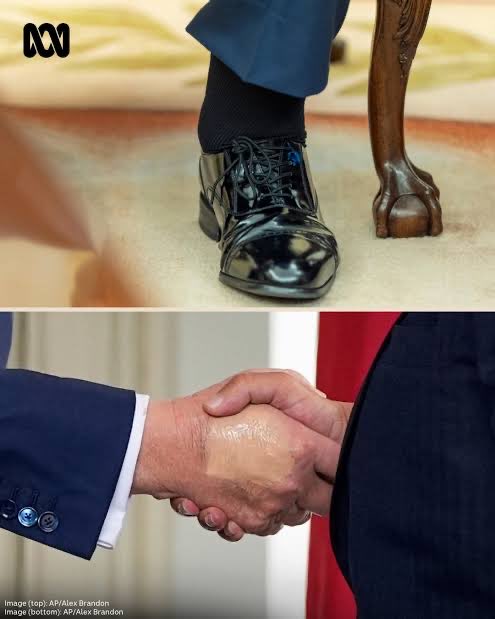Cathy2NotToday's tweet photo. “Dr Reiner dismantled the official narrative by pointing out three distinct anomalies that the White House medical team has desperately tried to minimize.

🚩First is the severe, unexplained bruising on the president’s hands. While the White House communications team scrambled to attribute the deep discoloration to "vigorous handshaking," Dr. Reiner stated flatly that the explanation is ••medically impossible and insulting to basic human observation. 

🚩Second is the visible swelling of the ankles. The White House diagnosed the condition as chronic venous insufficiency, but Reiner noted a glaring internal contradiction: 🎇just one year ago, Trump’s official examination disclosed zero edema whatsoever. 

“Which would then make it ••acute venous insufficiency,” Reiner explained, “which is an entirely different thing.” Unlike a chronic condition that develops over decades, sudden acute edema acts as an immediate red flag for severe underlying pathologies, including congestive heart failure.✅✅✅🎯🎯( I see these signs as a repeat of my dad who died from CHF)

🚩Third, and perhaps most alarming, is the severe daytime somnolence. Dr. Reiner highlighted a documented pattern of the president repeatedly falling asleep in the Oval Office and the Cabinet Room while advisors are actively speaking to him. More critically, Reiner raised concerns that the commander-in-chief appeared to nod off during the solemn Memorial Day observances at Arlington National Cemetery just yesterday, on Monday. 

While expressing confidence that the medical team has conducted sleep tests for apnea, Reiner warned that chronic insomnia in an older patient is a severe clinical illness that accelerates cognitive decline, dementia, and cardiovascular failure…effectively adding three and a half years to a patient's biological age 

This was Trump’s fourth medical evaluation of his second term, revealing a frantic pace of examination that breaks completely with historical norms. While modern presidents typically visit Walter Reed once a year, Trump took two unannounced trips in 2025 alone…including an October visit initially cloaked as a routine MRI before later being exposed as a CT scan. 

This pattern of defensive, imprecise disclosure is exactly what Reiner has been warning the public about for months, telling the Washington Post that the administration exhibits a calculated and dangerous "lack of candor."

Reiner is now calling for mandatory, independent presidential health disclosures to Congress, noting that we require strict fitness-for-duty certifications for commercial pilots, Secret Service agents, and school bus drivers, yet allow the commander of the world's most powerful military to operate in a total medical vacuum. 

The president posted “PERFECT” and the White House promised “excellent overall health.” But the bruising is visible. The ankle swelling is visible. The daytime nodding off is visible. The American public is not required to choose an aggressive Truth Social post over the evidence of their own eyes. 

They are entitled to demand that the massive gap between propaganda and reality be explained by someone with medical credentials and zero allegiance to the man on the table. 

The chart says one thing. 

The body says another”

Excerpt from https://t.co/cg4XHAR0a9