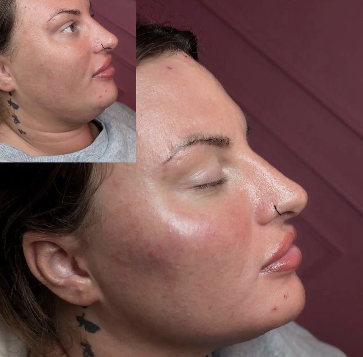 facesbyfaria's tweet photo. Side profile glow-up ✨
Sometimes the smallest tweaks create the biggest difference.

Can you spot what was treated? 👀 https://t.co/pFFMwx8GGQ