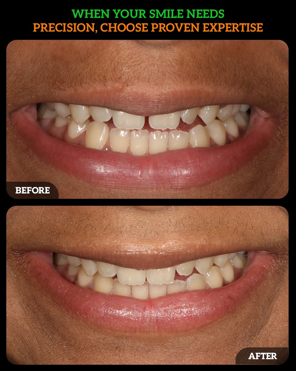 DMDGroup's tweet photo. Gaps between teeth aren’t just about aesthetics; they can impact alignment, bite, and overall oral health. With Invisalign clear aligners, you effectively close gaps without the hassle of metal braces.
Call - (614) 766 5600.
#InvisalignSmile #CloseTheGap #ClearAligners https://t.co/d0ZOp5gYji