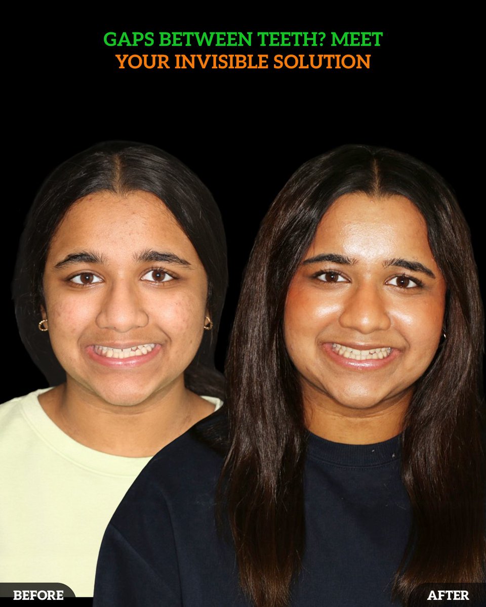 DMDGroup's tweet photo. Gaps between teeth aren’t just about aesthetics; they can impact alignment, bite, and overall oral health. With Invisalign clear aligners, you effectively close gaps without the hassle of metal braces.
Call - (614) 766 5600.
#InvisalignSmile #CloseTheGap #ClearAligners https://t.co/d0ZOp5gYji