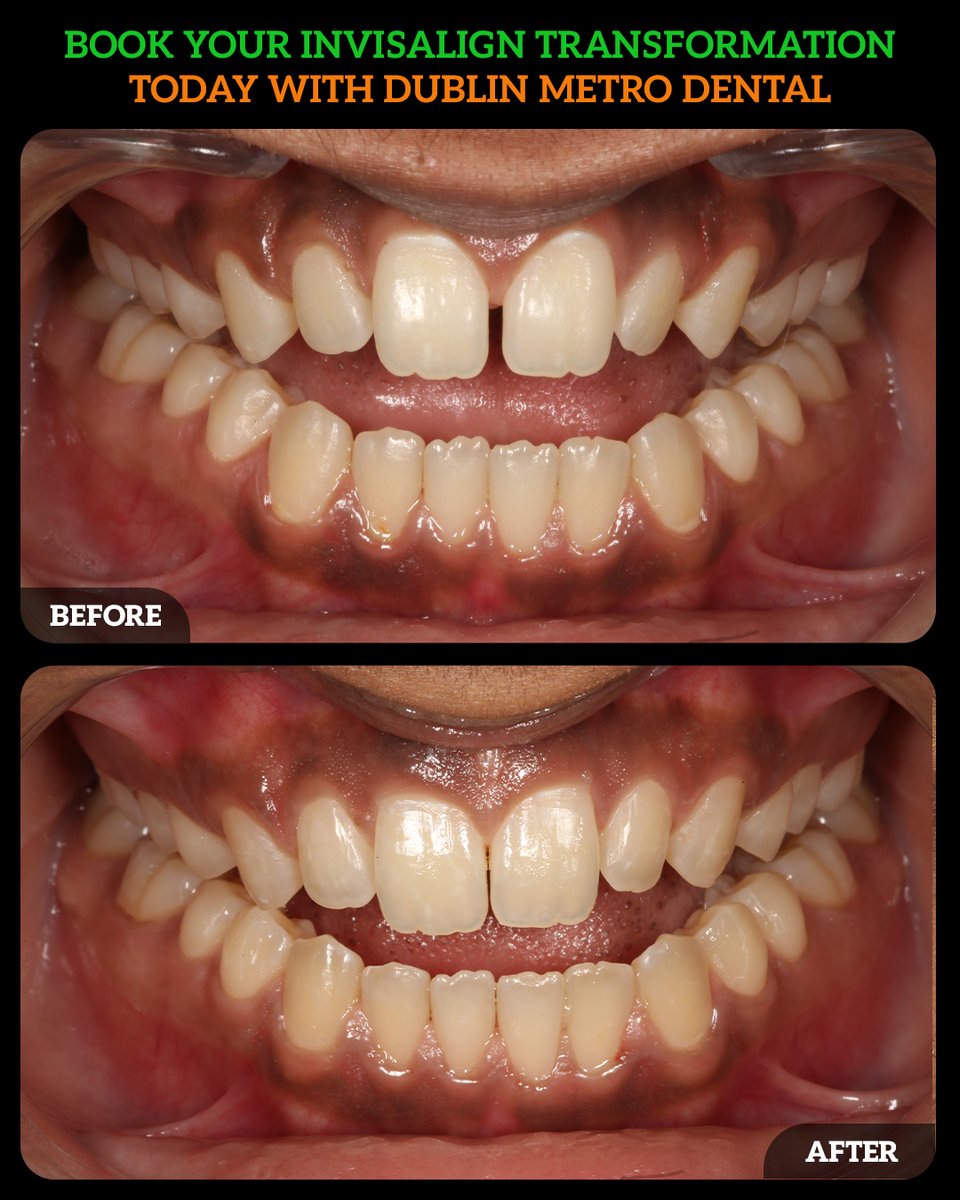 DMDGroup's tweet photo. Gaps between teeth aren’t just about aesthetics; they can impact alignment, bite, and overall oral health. With Invisalign clear aligners, you effectively close gaps without the hassle of metal braces.
Call - (614) 766 5600.
#InvisalignSmile #CloseTheGap #ClearAligners https://t.co/d0ZOp5gYji