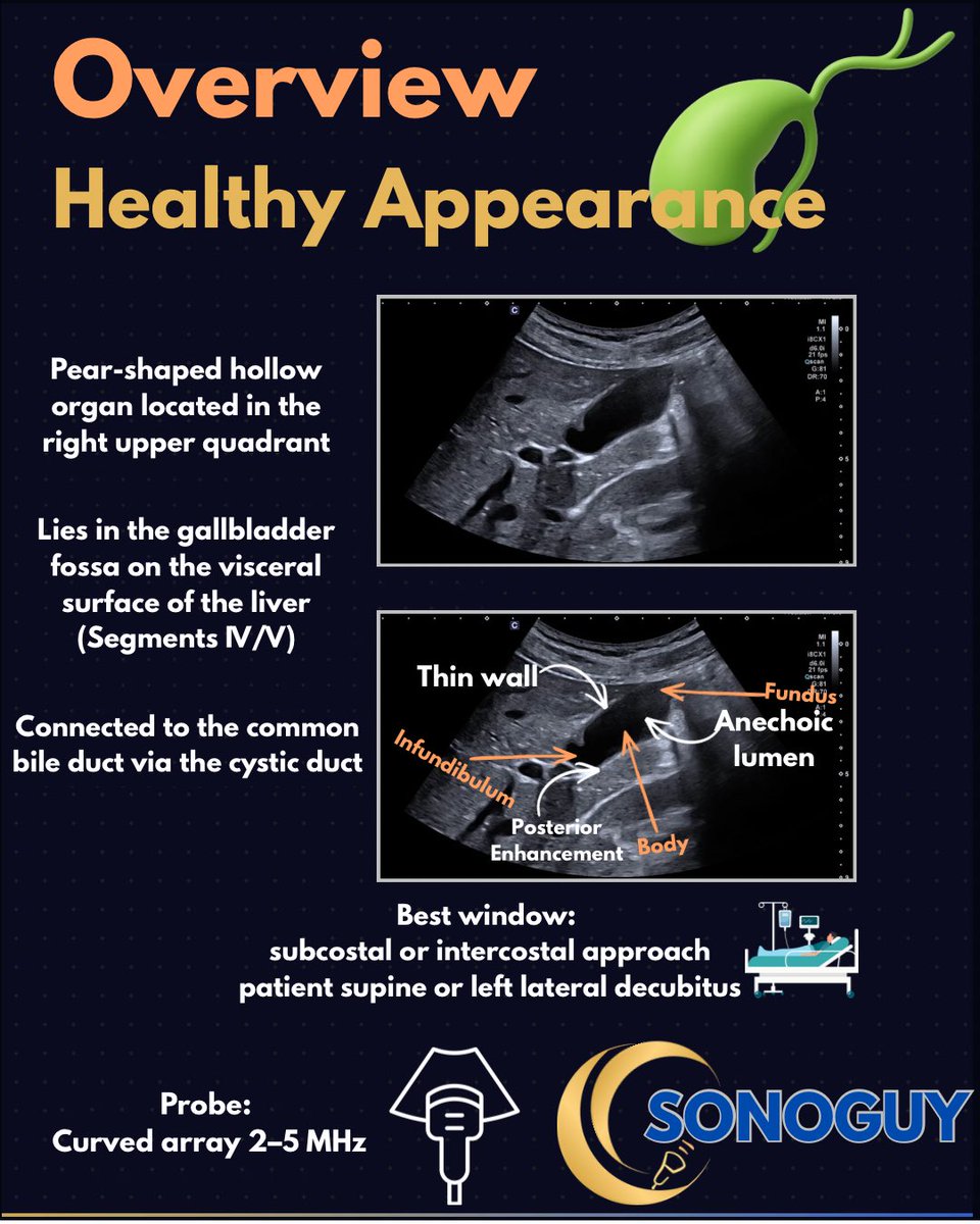 The_sonoguy's tweet photo. The gallbladder is one of the most scanned organs in abdominal ultrasound.

It’s also one of the most misread.

This carousel covers everything you need to know — anatomy, pathologies, classic pitfalls, and a full scanning checklist. 🧵👇 https://t.co/AgYWO41O7f