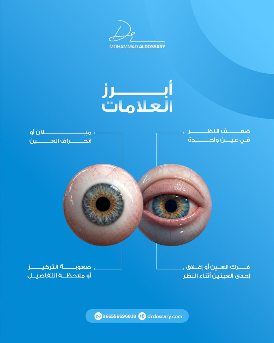 DOZARY's tweet photo. العين الكسولة ليست مجرد ضعف نظر…
بل مشكلة قد تؤثر على تطور الرؤية عند الطفل إذا لم تُكتشف مبكرًا.

#دكتور_محمد_الدوسري #صحة_العيون #تصحيح_النظر #الليزر #المملكة_العربية_السعودية https://t.co/sI7yfDUw6N