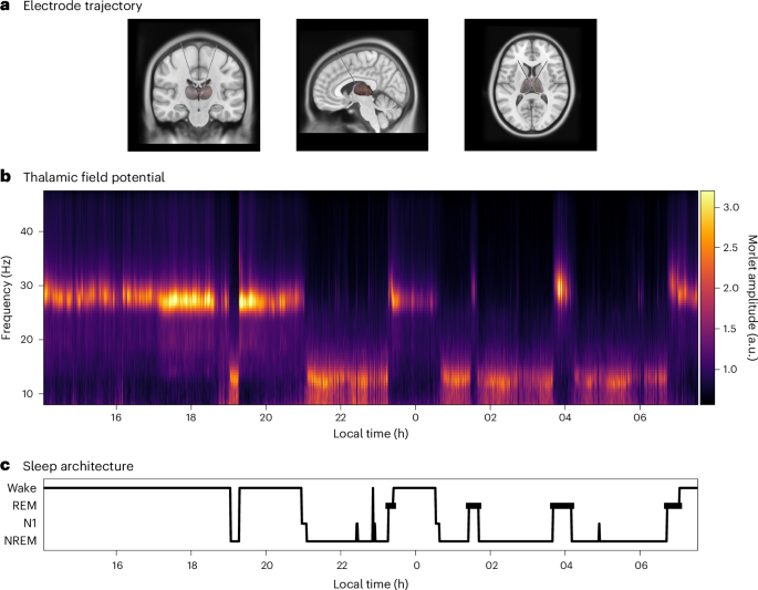 NatureHumBehav's tweet photo. Thalamic oscillations distinguish natural states of consciousness in humans https://t.co/vH5bG8CjNz https://t.co/Jjh4r8NI71
