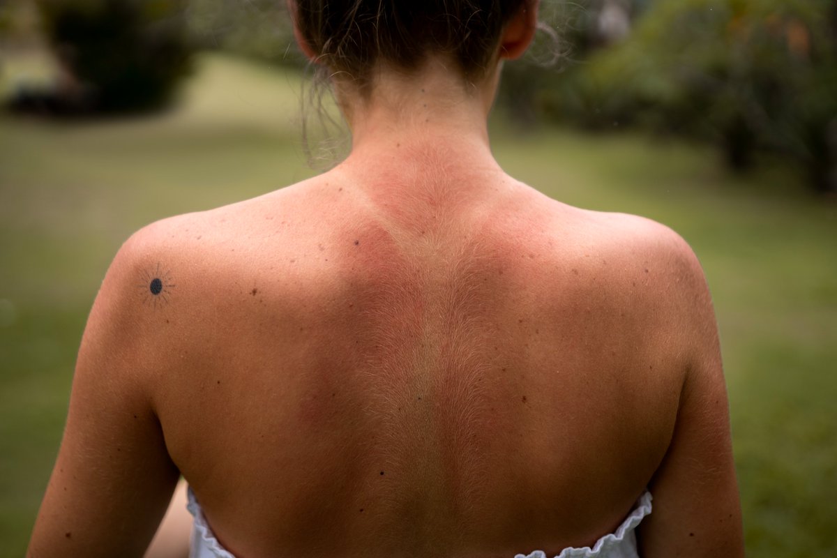 HSJDChile's tweet photo. Melanoma: el cáncer de piel que hoy afecta a personas cada vez más jóvenes✍️ El Doctor, Enrique Morales, entrega detalle de los efectos de la exposición al sol y su daño. 👉https://t.co/1znsCMJRBP https://t.co/Vm0i6lq29D