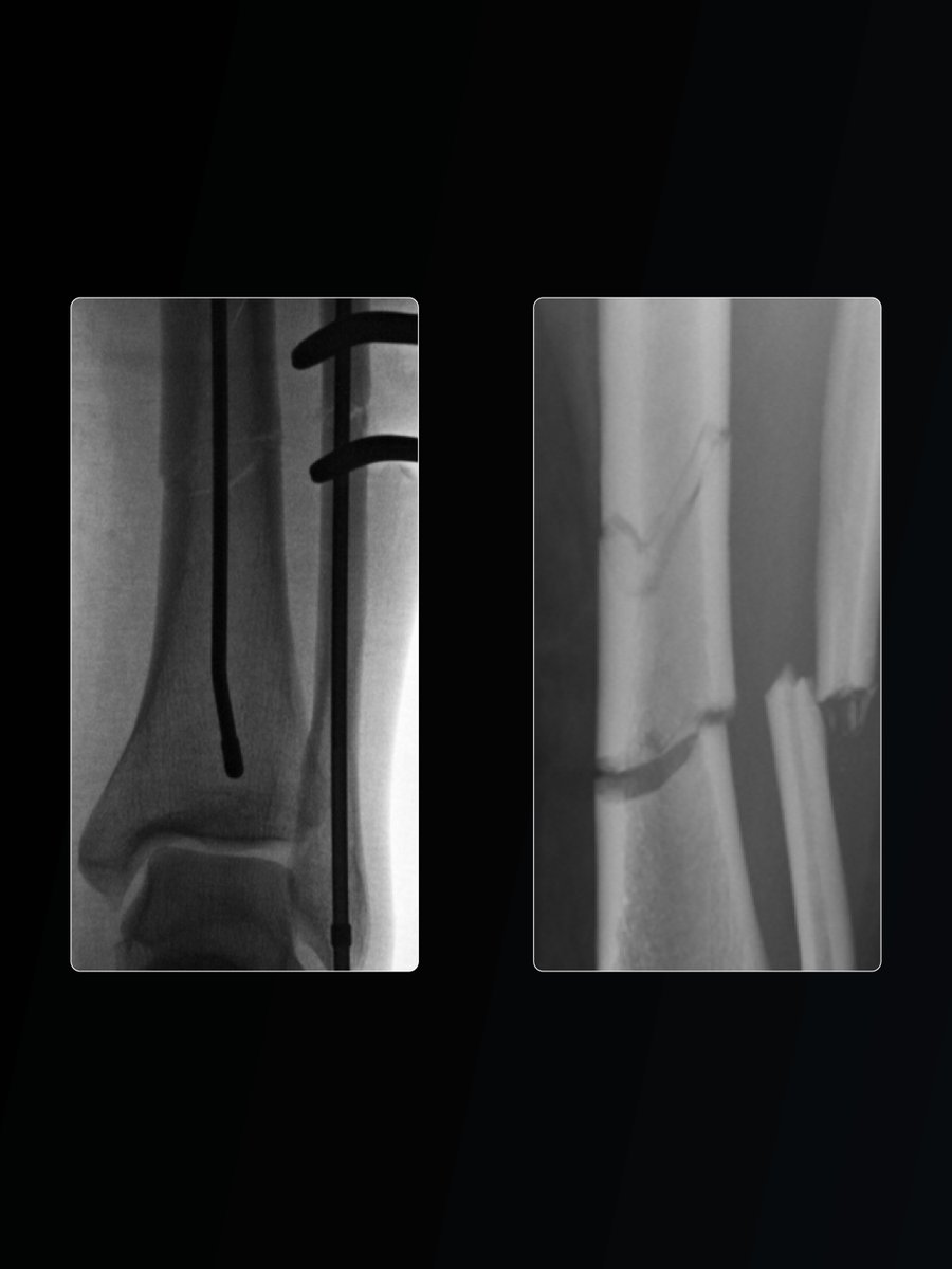 ArthrexMedEd's tweet photo. A 35-year-old female sustained a 12-foot fall while rock climbing. Imaging confirmed a closed, comminuted fracture of the distal tibial and fibular shafts, with no additional injuries identified.

During the procedure, a limited open approach was used to reduce the fibula, restore fibular length, and assist with reduction of the tibial fracture. Stabilization with the FibuLock® reamer provisionally helped maintain alignment and allowed further fine-tuning of the tibial reduction using a percutaneous clamp.

The Arthrex tibial nail was then inserted using a suprapatellar approach. The distal locking screws were placed first to permit a small backslap maneuver and achieve additional compression at the fracture site. After tibial fixation was completed, the FibuLock fibular nail was inserted to stabilize the fibula.

Courtesy of Corey Rosenbaum, DO

Learn more: https://t.co/QFw1E5KwsX