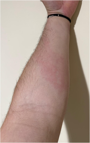 worldallergy's tweet photo. #WAOJournal: Concurrent #hereditary #angioedema type I and #common #variable #immunodeficiency presenting as suspected #antibiotic #hypersensitivity: Case report and literature discussion. Open Access. https://t.co/OJtaLvgxdb https://t.co/B7hyNWM8wt