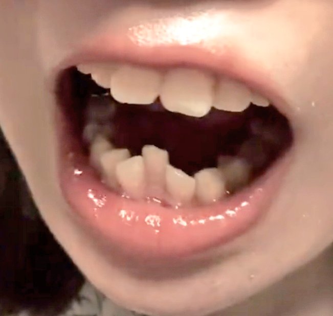 Tooth___fetish's tweet photo. Tiktokで流れてきた子
矯正したいけどその前に多量の虫歯治療中らしい😯 https://t.co/LRgSDfduOc