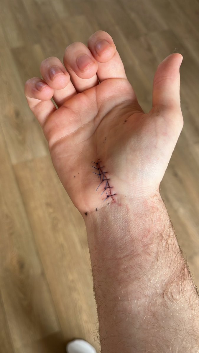 NotFreq's tweet photo. Surgery went well, I’ve now been recovering for a good 4 weeks and everything is going as planned. Cya for enc quals and stage 1 😼 https://t.co/ocEQh1fB26