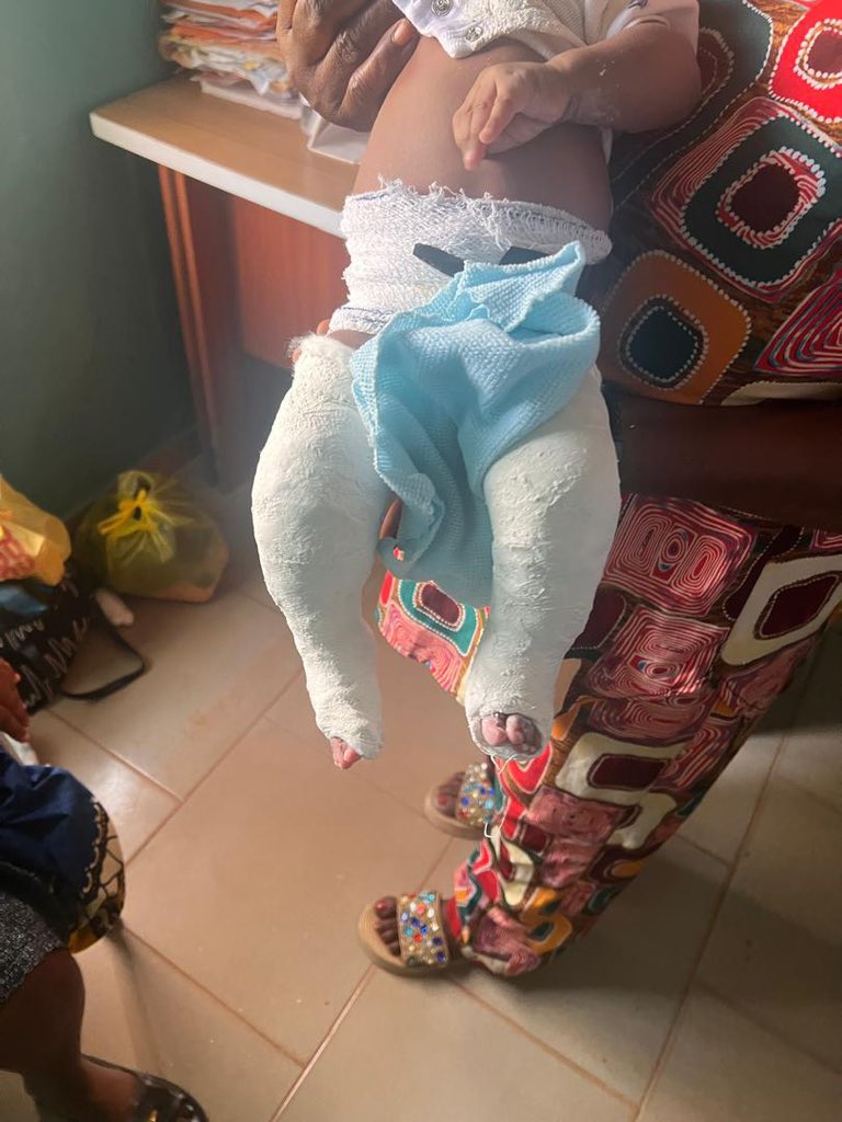 healthertainer's tweet photo. 🙏🏻Please repost this to #SaveBabyMiracle 

 He has HYDROCEPHALUS (excess cerebrospinal fluid (CSF) in the brain as a result of Spina Bifida (gotten as a result of mom not taking folic acid during pregnancy)

He needs a BRAIN SURGERY immediately 

MRI shows that if surgery is not done immediately to remove the water in his brain, it can cause blindness, seizures, delayed development and total loss of brain function, etc, even death. 

Heal for Africa initiative 
6060313332
Fidelity bank

He is currently on treatment to heal the surgery site and correct his feet (in club foot, muscles and tendons around the foot become unbalanced, causing the foot to twist inward and downward. He just received the 3rd stage of casting)

 but the BRAIN SURGERY is VERY URGENT to preserve his brain function and development 🙏🏻

We need at least 3 - 5million Naira for a start