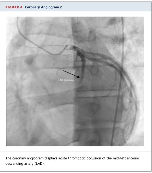 ZKholaif68047's tweet photo. 📣 New in @JACCJournals 

“From Nonobstructive Plaque to LAD Thrombosis in a 26-Year-Old”

🏋️ 26-year-old Athlete 
⚠️ Heavy anabolic steroid + energy drink use
🫀 Initial angiography: nonobstructive LAD plaque
🚨 Weeks later: acute thrombotic LAD occlusion causing anterior STEMI https://t.co/UVQ0X8J4yo