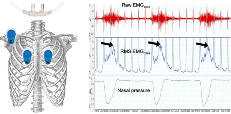 ExpPhysiol's tweet photo. Rebecca F. D'Cruz, Dominic Wilkins, Caroline J. Jolley (@GSTTnhs, @KingsCollegeLon, @KingsCollegeNHS) explore exercise-induced dynamic hyperinflation in chronic obstructive pulmonary disease 

📖 https://t.co/FpoJaRlOuc https://t.co/z6lE41RxDa