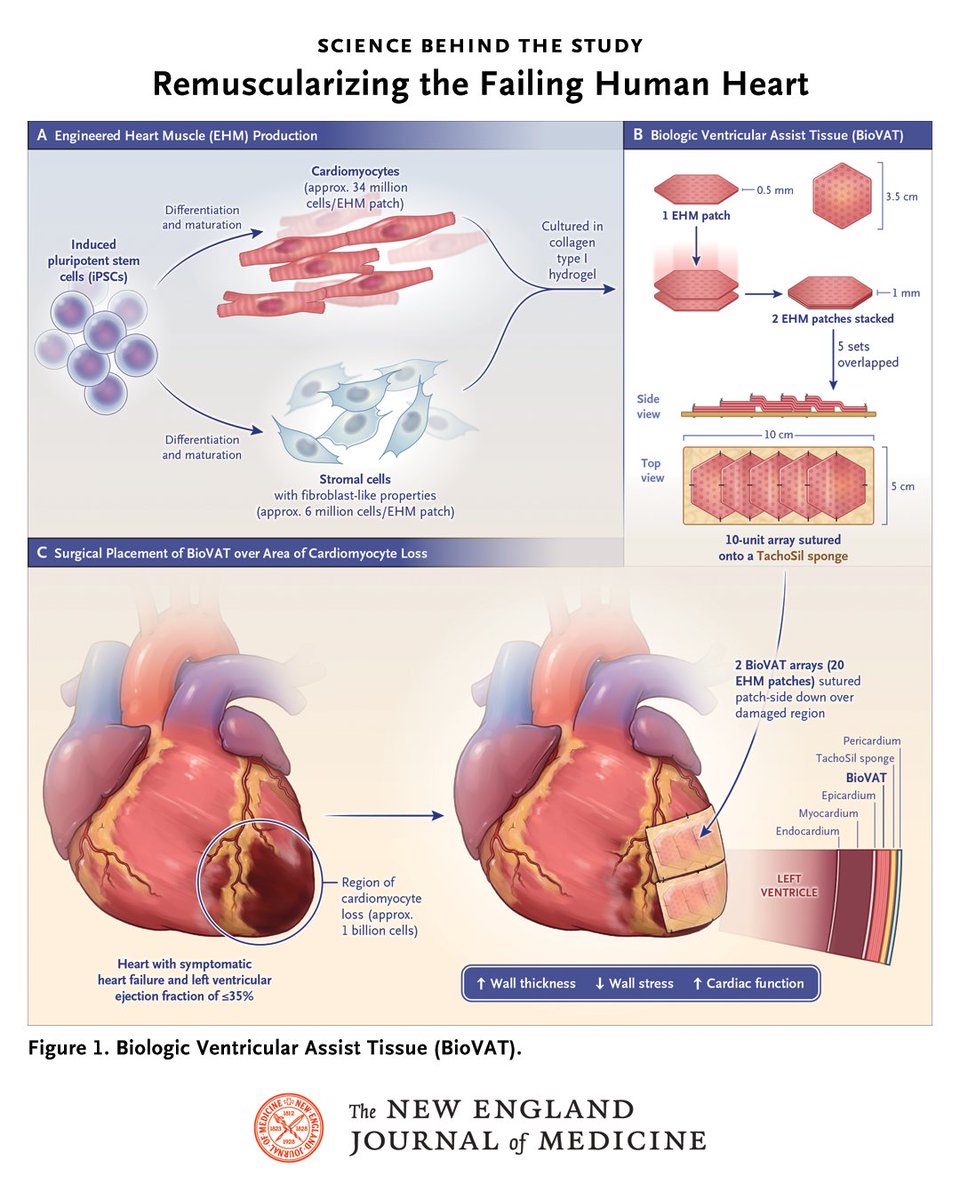 NEJM's tweet photo. Deepak Srivastava, MD, describes the scientific foundations of a phase 1–2 study of stem-cell–derived ventricular assist tissue transplanted onto the epicardial surface of failing human hearts. 

Learn more about the science behind the study in the editorial “Remuscularizing the Failing Human Heart,” from @GladstoneInst and @ucsf: https://t.co/MxkB8fdQNd