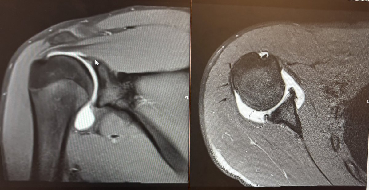 CashtonSedlar31's tweet photo. After a very hot start to my highschool season I unfortunately tore my labrum. Recovery starts now.

Stats  B4 injury
10/15
4 1B 3 2B 2 3B 1 HR
.722 OBP
.1333 SLG
.2056 OPS
10 R
8 RBI
3 BB

C/O 27
6’0 175
6.7 60
100 EV
92 OF
@StateLineStars 
@bhs_bbboost https://t.co/jJGlUT1fYu