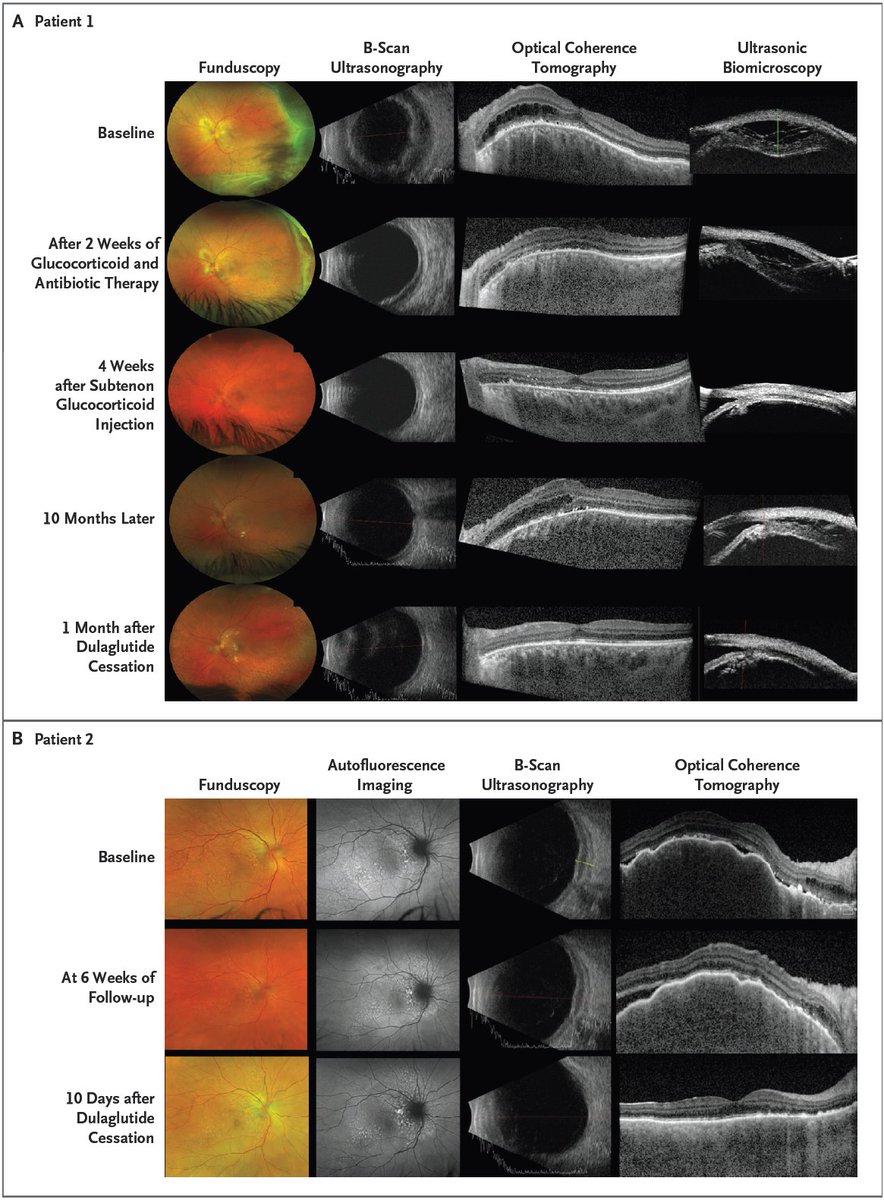 NEJM's tweet photo. Correspondence: Dulaglutide-Associated Choroidal Lymphoid Hyperplasia https://t.co/E7IZNZNduk

#Endocrinology #Ophthalmology https://t.co/4P7BJoEDST