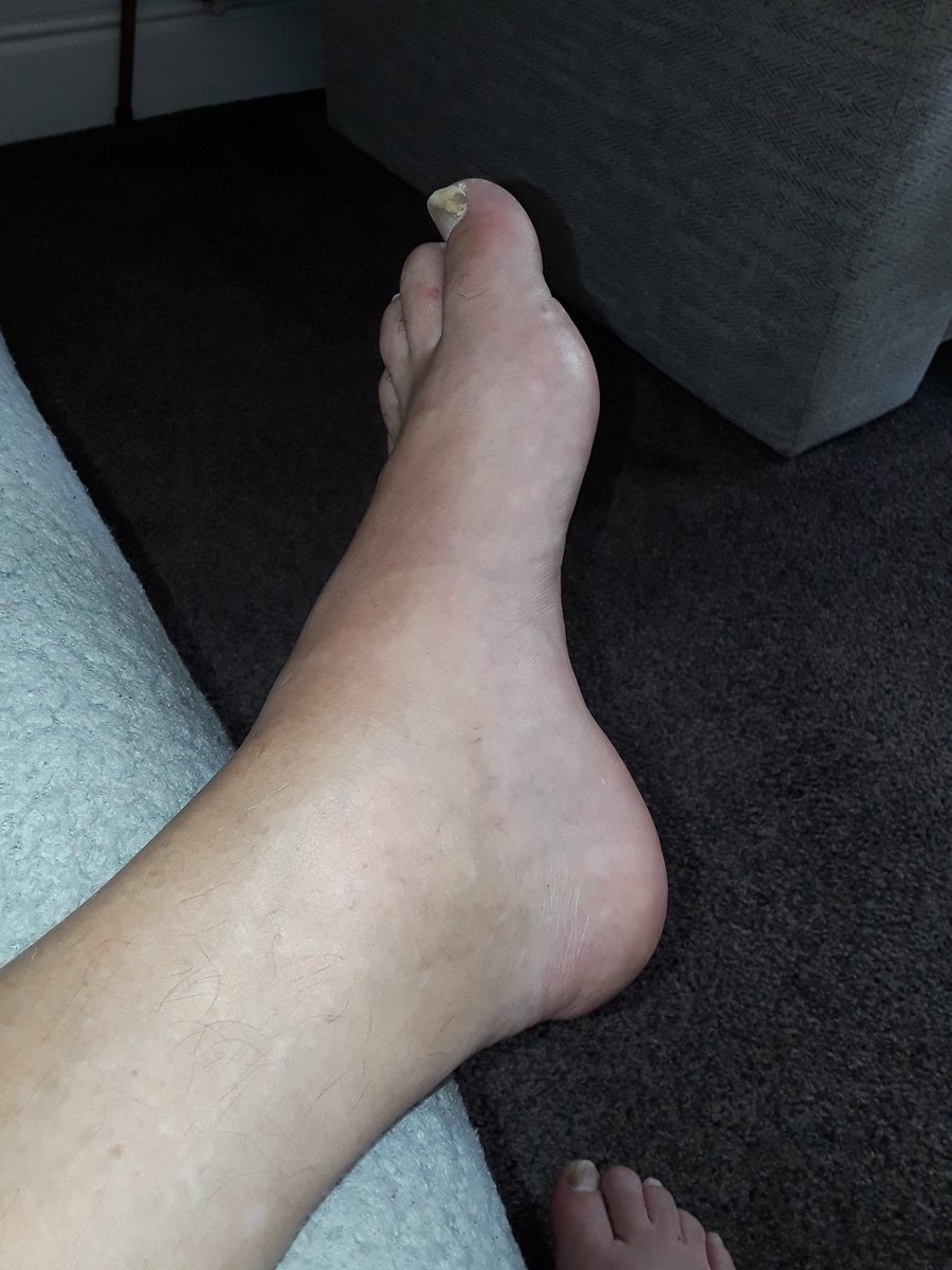 SeanCoglan's tweet photo. Finally plucked up the courage This afternoon to take the Methotrexate ive been prescribed, currently feeling a bit washed out, but currently managing ok, let's hope the night goes ok &amp; I get to take my Folic acid and things work out ok #invisabledisability @arthritisukorg #NHS https://t.co/W3XwjVAPZe