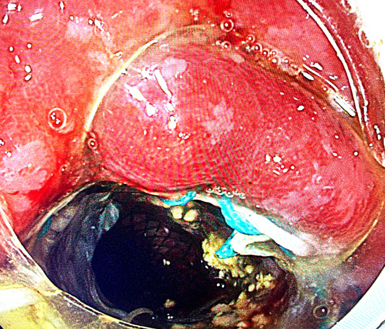 FrontGastro_BMJ's tweet photo. Therapeutic upper GI endoscopy is moving fast — what’s new? 🚀🔦

Part 1 of this new @FrontGastro_BMJ update reviews advances in therapeutic upper GI endoscopy, highlighting emerging techniques, evolving indications and the expanding role of endoscopists in complex upper GI care. 🧑‍⚕️📸

A great read for anyone keeping up with innovation at the sharp end of endoscopy.

Read more: https://t.co/qbEkZmOnOk

#UpperGI #TherapeuticEndoscopy #Endoscopy #EndoscopyInnovation #Gastroenterology #FrontlineGastro #GItwitter #EndoscopyTraining #MedEd #ClinicalPractice @anjan_dhar6 @BritSocGastro @my_UEG @AmCollegeGastro @DDWMeeting @ESGE_news @drkeithsiau @DrOmerAhmad @Dunnepdj @shraddha_gulati @CardiffGastro @DrBuHayee @poodocnisha @Sharm_Sub @PhilSmithIsBack @OTavabie @dr_aditi_kumar @TrevorTabone @eathar_s @IrenePerezMD @KGananandan @zare_benjamin @medicalreg @dtleiberman