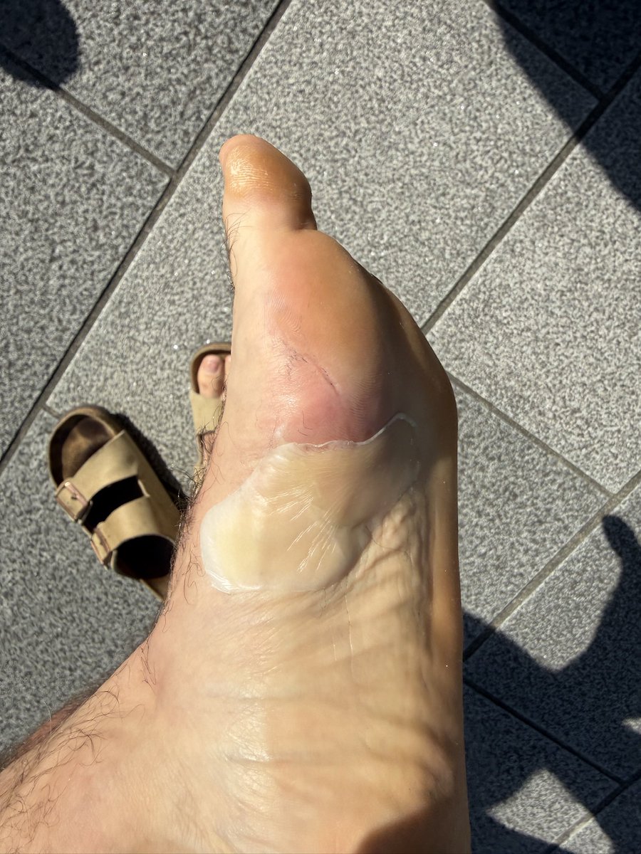 jpralston15's tweet photo. @Brady_H Brady I wore these in Tokyo and ended up developing the worst blister of my life on my left foot. Mostly due to juking through crowds. I’ve had great success with the saucony endorphin elite at London and Boston. https://t.co/lJk3jsSldm