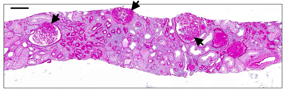 Renalpathsoc's tweet photo. Renal Pathology Society's Case in Focus
Middle-aged male with HTN &amp; CKD presented with nephrotic range proteinuria
Rita Santarsiere &amp; Nicolas Kozakowski 
English: https://t.co/7LFCD7VgNC
Links to translations (Spanish, Portuguese, French, Chinese) in next post below
#renalpath https://t.co/6J9WdsvNm5