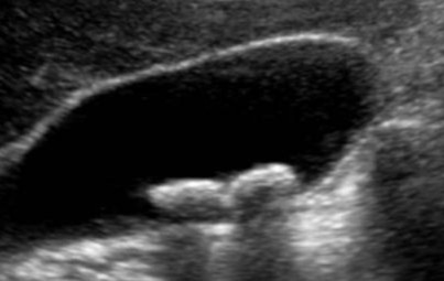 Dunnverah's tweet photo. Which of the following is the classic ultrasound finding of gallstones? 

A. Thickened wall without stones 
B. Fixed anechoic structures 
C. Hypoechoic foci without shadowing 
D. Hyperechoic foci with posterior acoustic shadowing and mobility https://t.co/gkr1Jd9VJ7