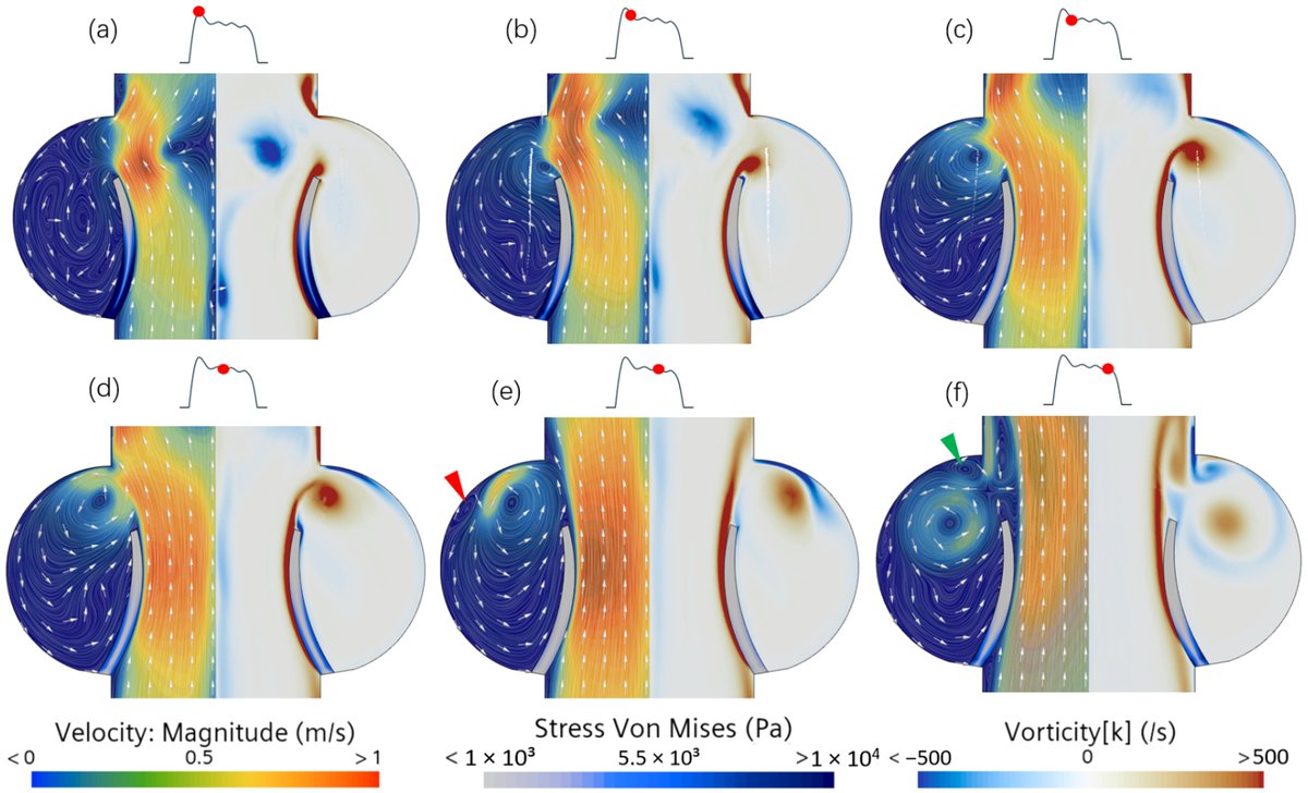 Bioeng_MDPI's tweet photo. 💥Excited for the publication: "Vortex Dynamics in the Sinus of Valsalva"
🔗https://t.co/kYH4TShnMQ
📌 #CardiovascularResearch #AorticValve #FluidDynamics #Biomechanics #ComputationalModeling #BiomedicalEngineering #HeartValve #MedicalResearch #Hemodynamics https://t.co/g4gveL0Jfi