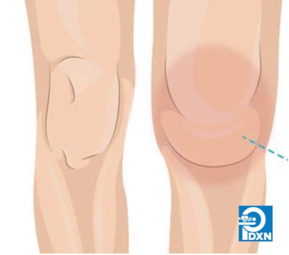 PDXN1's tweet photo. A joint effusion occurs when extra fluids flood the tissues around your joint. To help aid with your effusion at home, we advise using heat/Ice, or taking antibiotics. Make sure to also speak to your doctor about undergoing an Arthrocentesis. https://t.co/fLck5iB3jC