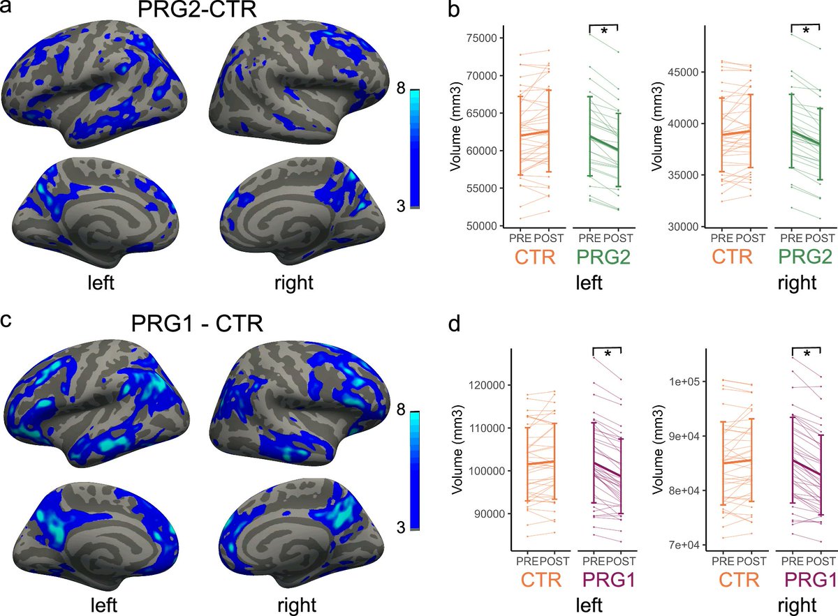 madeofgenes's tweet photo. A second pregnancy rewires the brain differently from a first, with stronger changes in attention networks and direct links to peripartum depression risk.

DOI: 10.1038/s41467-026-69370-8

#MadeofGenes integrates female-specific data as first-class signals. https://t.co/LuGyCH42HU