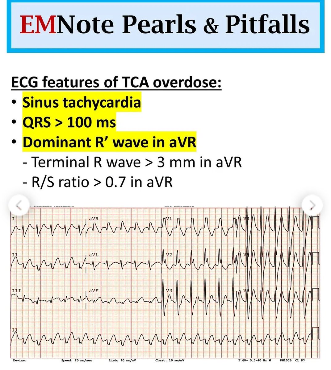 Avr Terminal R Wave This is the classic ECG pattern of tricyclic antidepressant (TCA ...