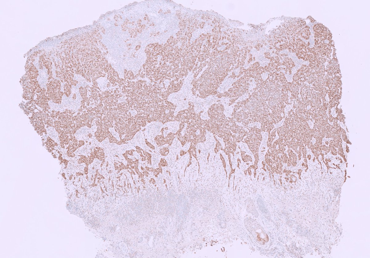 kis_lorand's tweet photo. 1/ Just a reminder that... the most common PRAME-positiv cancer in the skin is...😀
#dermpath #pathology
PRAME IHC 👇👇 https://t.co/bM52fohNuL