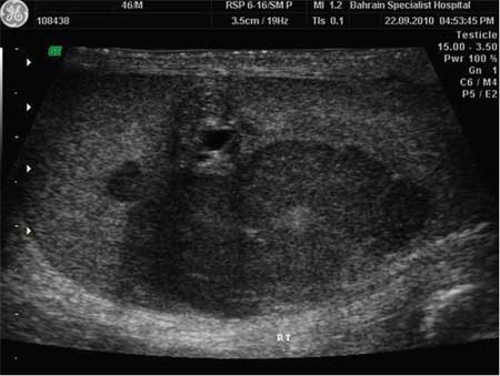 BMJBestPractice's tweet photo. Diagnose this patient🔽 

35yo man presents with non-specific testicular discomfort. On examination, a 2 cm by 1 cm smooth, painless mass is palpated in the right testis. The mass does not transilluminate with light. There is no lymphadenopathy.

https://t.co/TxbTqlafu2 https://t.co/GYZ1wxfhdw