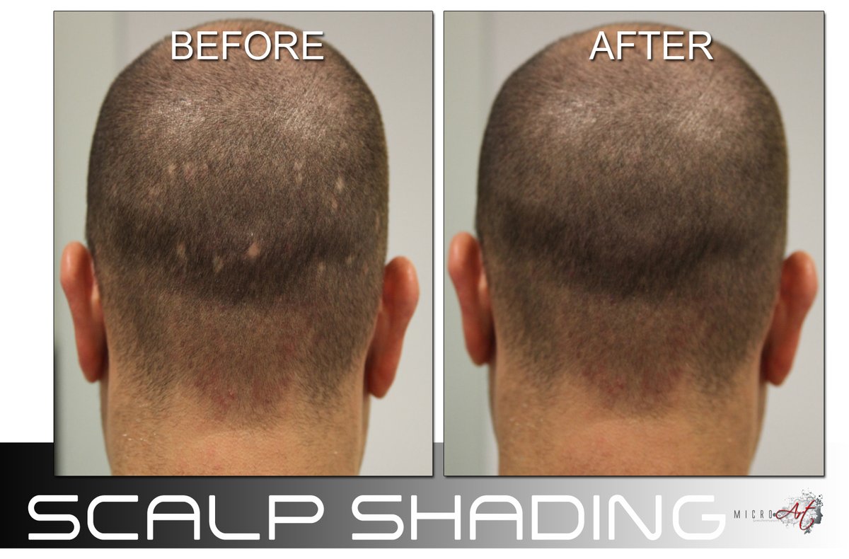 Micro_Art's tweet photo. Patches on the scalp, big or small, can terribly affect a person's way of living. Regain your confidence with Micro Art Scalp Shading!

More information here👉 https://t.co/unAFjJTO6S https://t.co/MQ6xewF4gC
