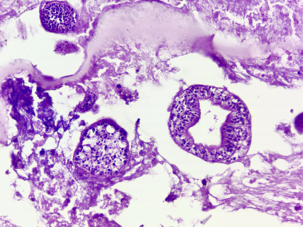 drlachit's tweet photo. Echinococcal cyst in lung of a 1 year old baby. https://t.co/69KGYymmeB
