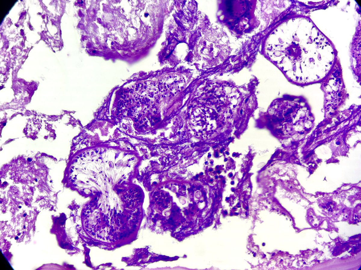 drlachit's tweet photo. Echinococcal cyst in lung of a 1 year old baby. https://t.co/69KGYymmeB