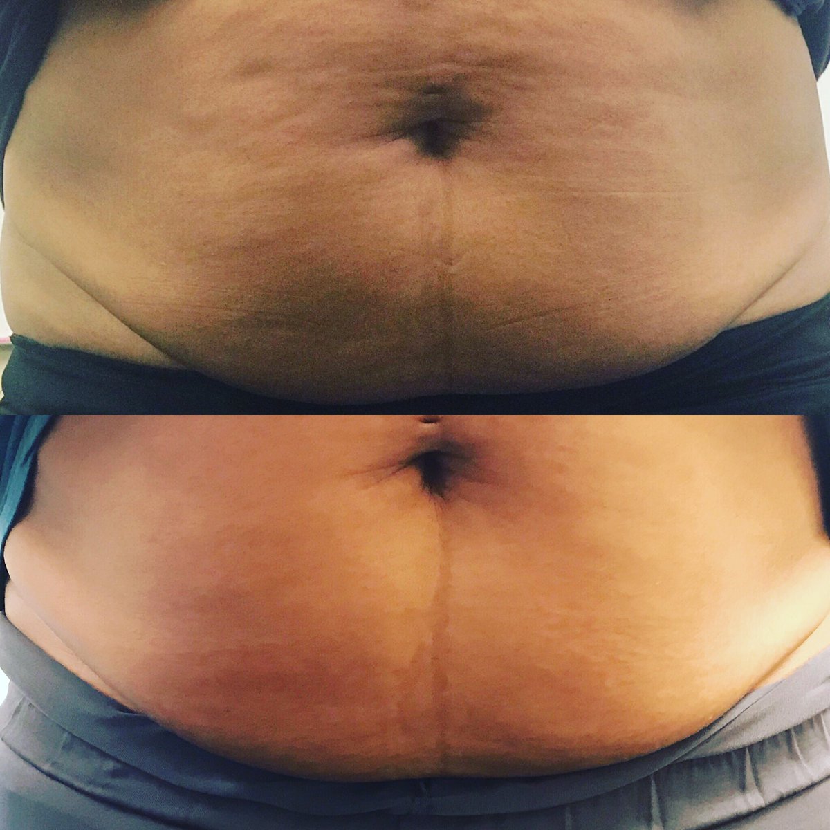 MLDInstitute's tweet photo. MLD: BEFORE &amp; AFTER 1 HOUR IN CLASS POST C-SEC https://t.co/CNtEnuWYzF