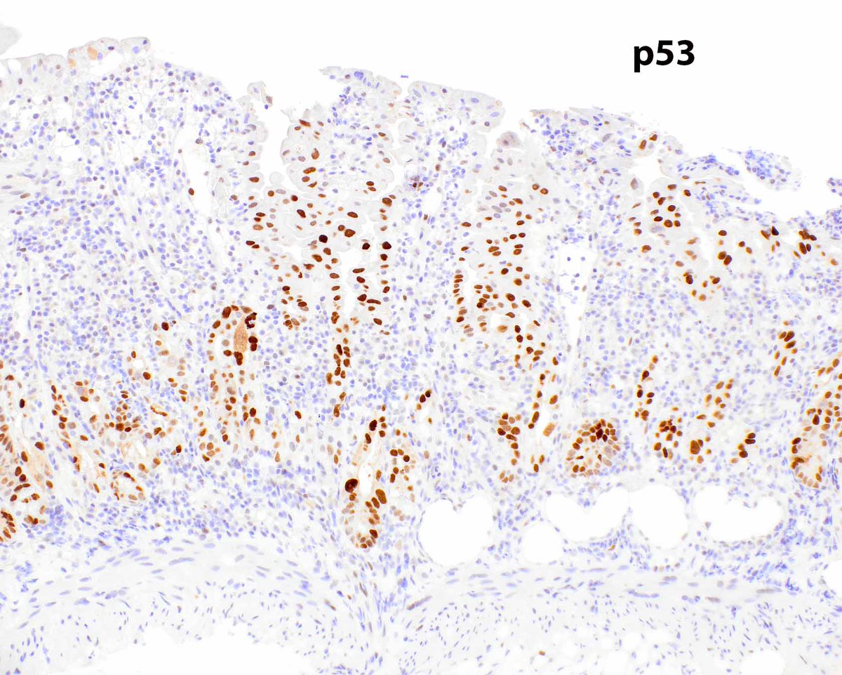 LizMontgomeryMD's tweet photo. Horrible treatment (radiation) associated epithelial changes in duodenal mucosa.  The p53 can be ignored, probably reflecting upregulation rather thana mutational event. The same can be seen in the stomach.
Hutchings DA, et al PMID: 36843539; PMCID: PMC10460459. https://t.co/F9aqrGfbBR