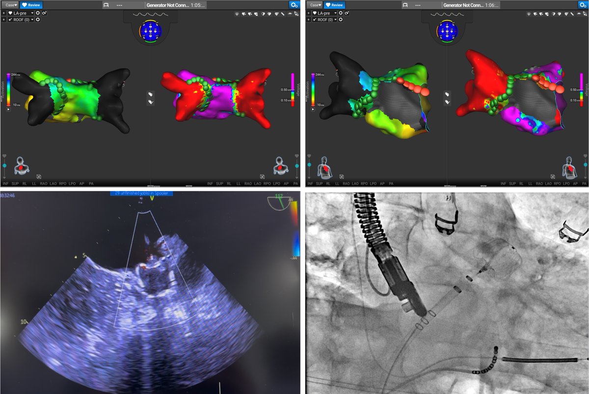 K_Letsas's tweet photo. First combined AF ablation using the Affera™ System and left atrial appendage occlusion using the WATCHMAN FLX™ device at Onassis Hospital. Special thanks to Dr. Matthias Käunicke for proctoring the case! 
@ipetemil  @Kariki_O @athsaplaouras @MEfraimidis 
#Epeeps https://t.co/DVTvIJkBEO
