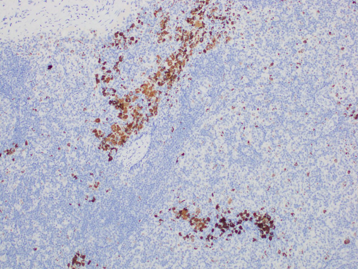 rezaesh58's tweet photo. 60 yo female with invasive ductal carcinoma , NHG3. 
S/P mastectomy and SLN excision. 

Lymph nodes with non-specific stain pickup for  melanocytic markers by melanin-laden macrophages, not melanoma or melanocytes. The keratin is also not positive-that's just the background melanin.  This pattern of melanin in the interfollicular/subcapsular region is seen in dermatopathic lymphadenopathy which is reactive lymph node enlargement in the setting of a rash/skin disease in the skin draining to that LN.

Please ensure that the condition is not referred to as metastatic carcinoma or melanoma.