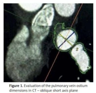 AdvIntervCardio's tweet photo. Atrial fibrillation (AF) is the most common arrhythmia, increasing the risk of stroke and all-cause mortality. Pulmonary vein isolation (PVI) with cryoballoon ablation (CBA) is a widely accepted approach for invasive treatment of patients with AF.
https://t.co/0yWoEFzNoc https://t.co/HRDQPYTJpH
