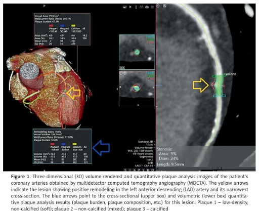 AdvIntervCardio's tweet photo. Atherosclerosis is a systemic disease, but the relationship between plaque characteristics in the coronary and carotid arteries remains unclear.
https://t.co/hqLUEJ38YW https://t.co/oOB3QAE0Qk