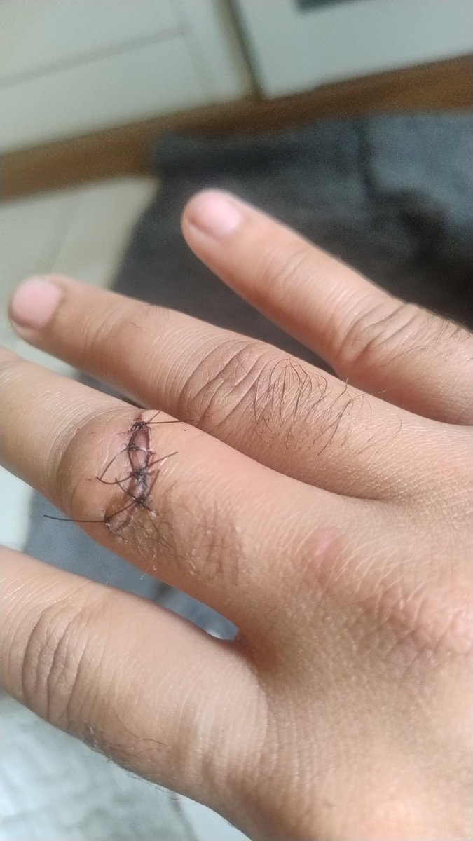jpjunio21's tweet photo. O resultado da Ida no hospital https://t.co/qdiHhgD7Ro